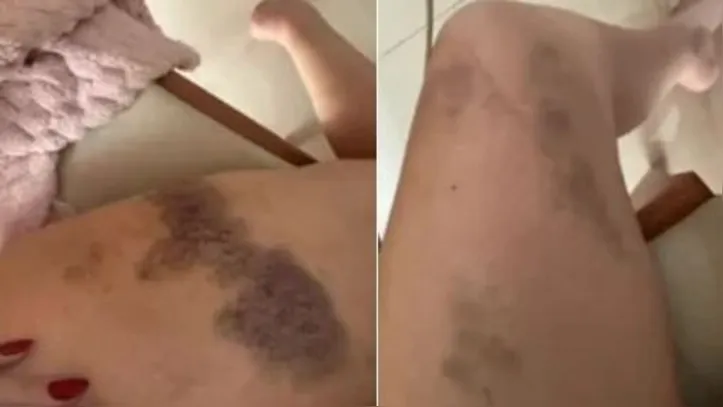 Flávia divulgou nas redes sociais imagens de lesões nas pernas