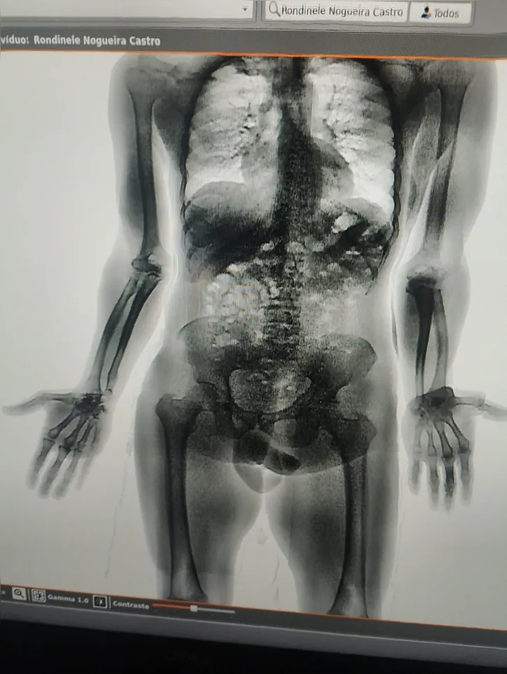 BodyScan apontou alterações nos dois casos
