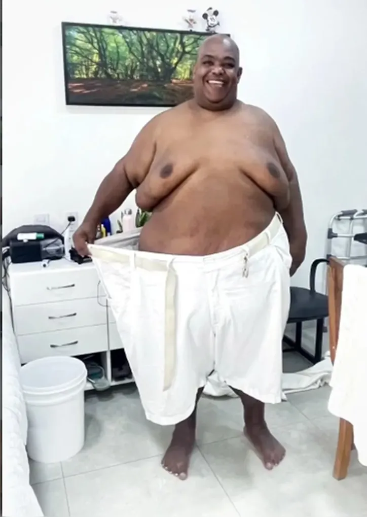 Babu após cirurgia bariátrica